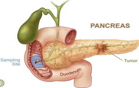 Vi khuẩn ngộ độc thức ăn giúp điều trị ung thư tụy