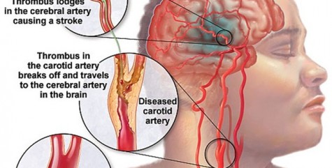 Cách nhận biết dấu hiệu đột quỵ