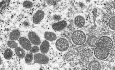 TP.HCM: Bệnh nhân đầu tiên mắc đậu mùa khỉ đã âm tính với virus