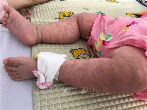 Từ đầu năm, cả nước ghi nhận 78 ca sốt phát ban nghi sởi, rubella